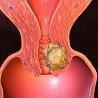 Симптомы рака шейки матки - советы врачей