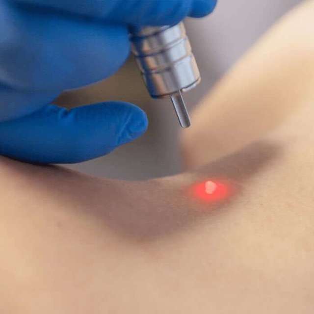 Лазерные операции удаления новообразований кожи - советы врачей