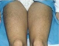 Эпиляция ног лазером - советы врачей