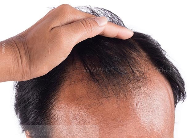 Выпадение волос - советы врачей