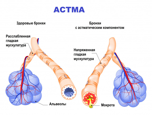 Диагностика и лечение бронхиальной астмы - советы врачей