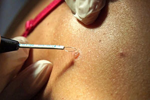 Лазерные операции удаления новообразований кожи - советы врачей