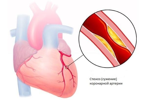 Оценка риска стенокардии и инфаркта - советы врачей