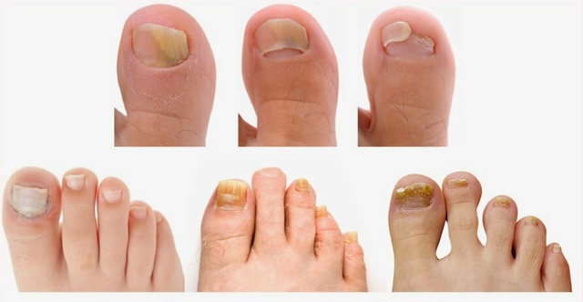 признаки грибка ногтей - советы врачей