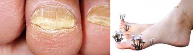 Грибок ногтей - советы врачей
