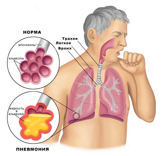 Лечение пневмонии - советы врачей