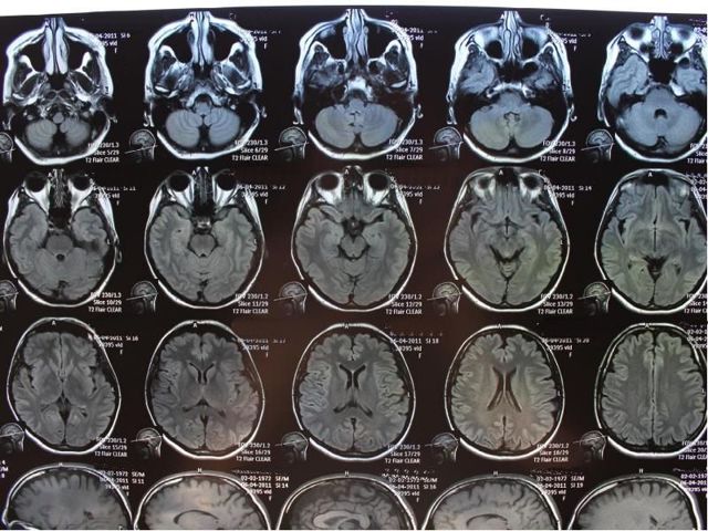 МРТ головного мозга - советы врачей