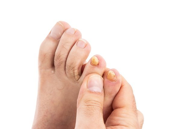 Патент на лечение грибка ногтей - советы врачей