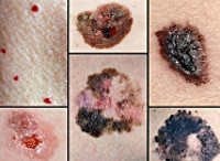 Злокачественные новообразования кожи - советы врачей