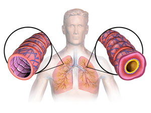 Симптомы астмы - советы врачей